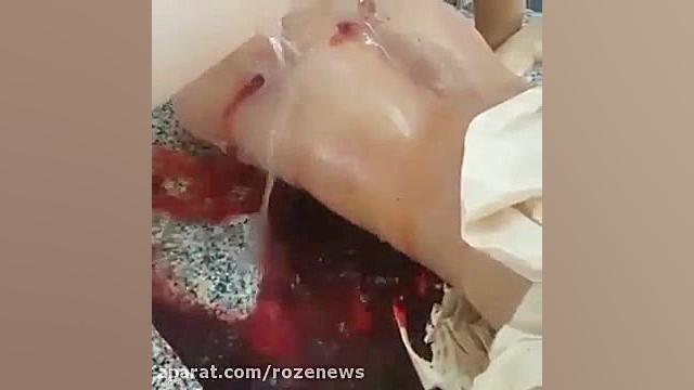 پس از 24 ساعت خون تازه از پهلوی شهید بحرین خارج می شود
